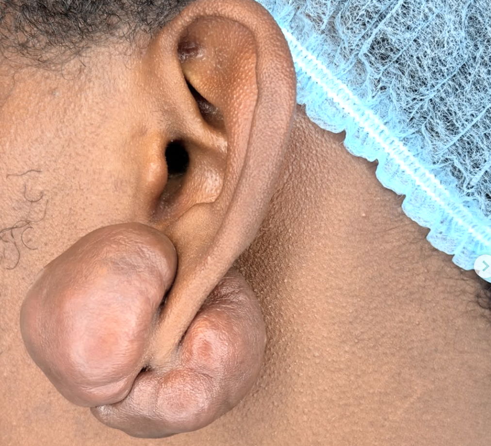 Cicatríz queloide desarrollado en oreja sin tratamiento aún