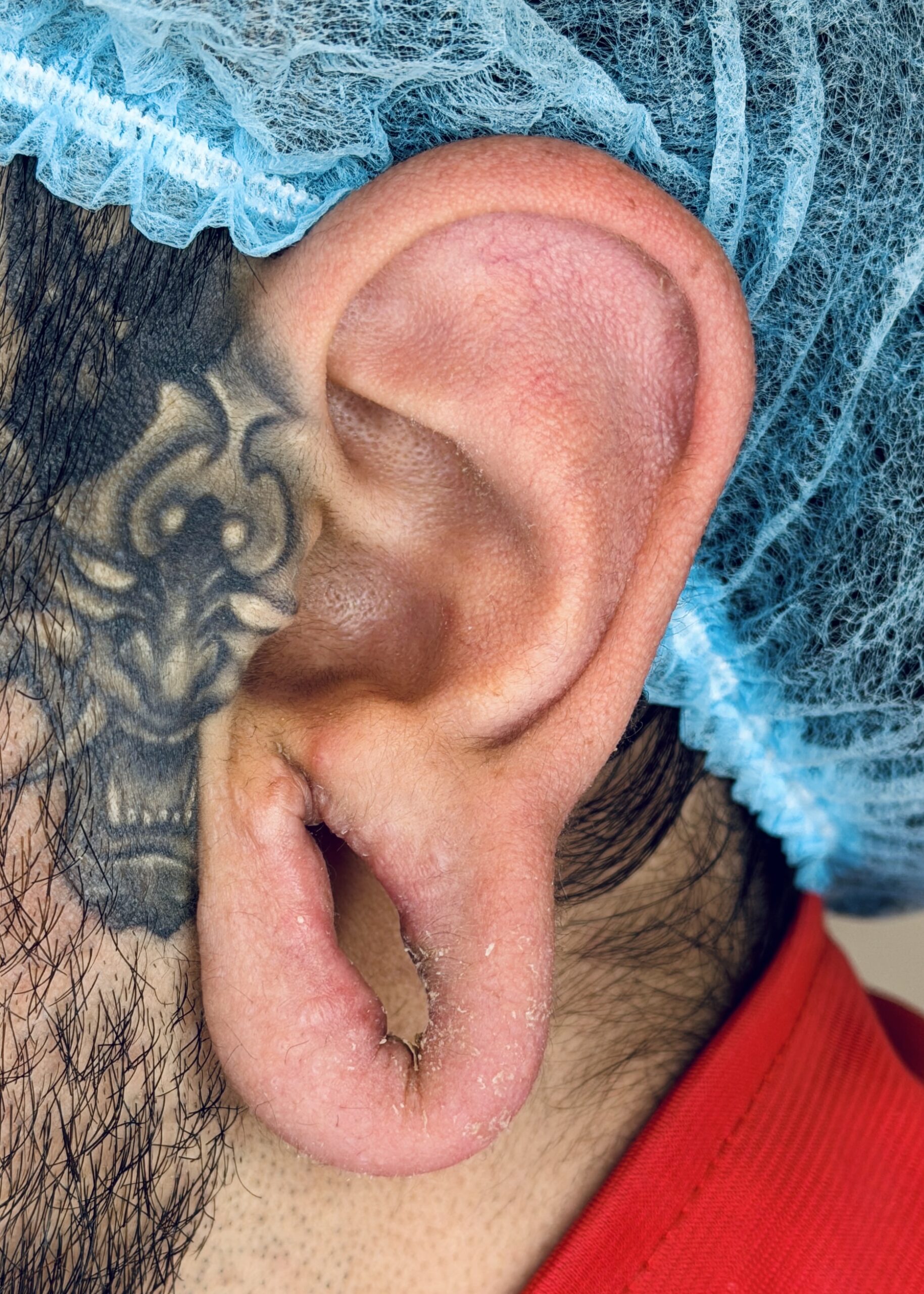 Lobuloplastia Dr. Camilo Barreto