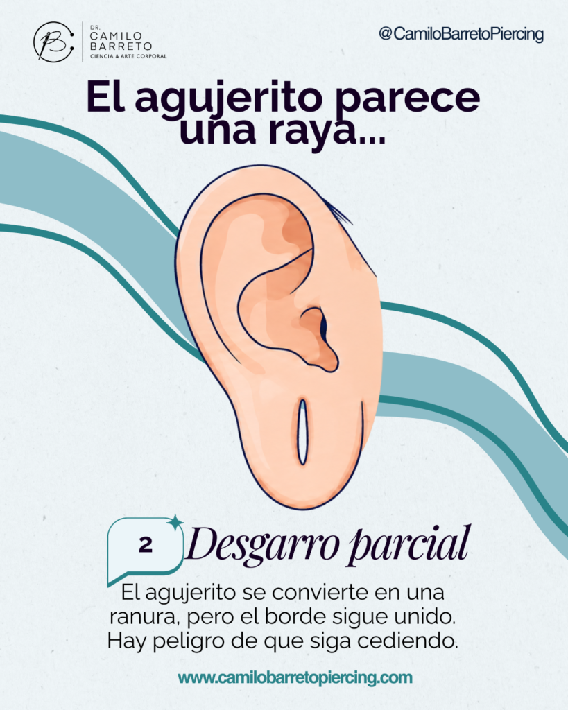 Lobuloplastia Camilo Barreto Piercing 4