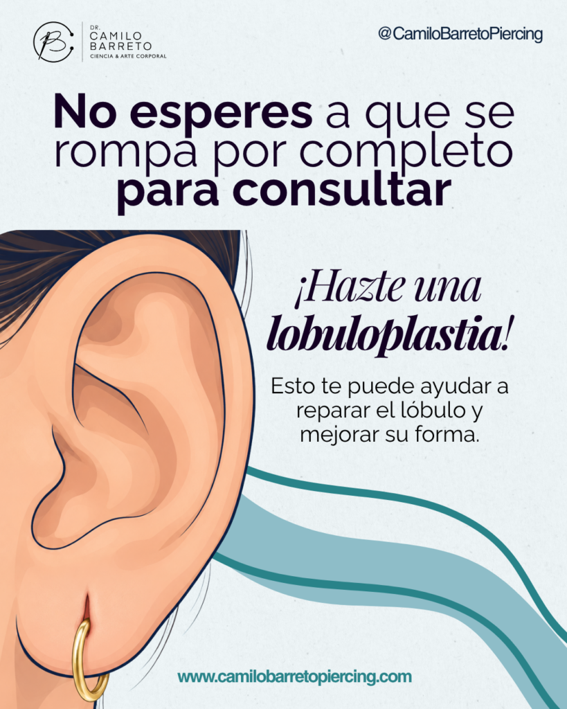 Lobuloplastia Camilo Barreto Piercing 1